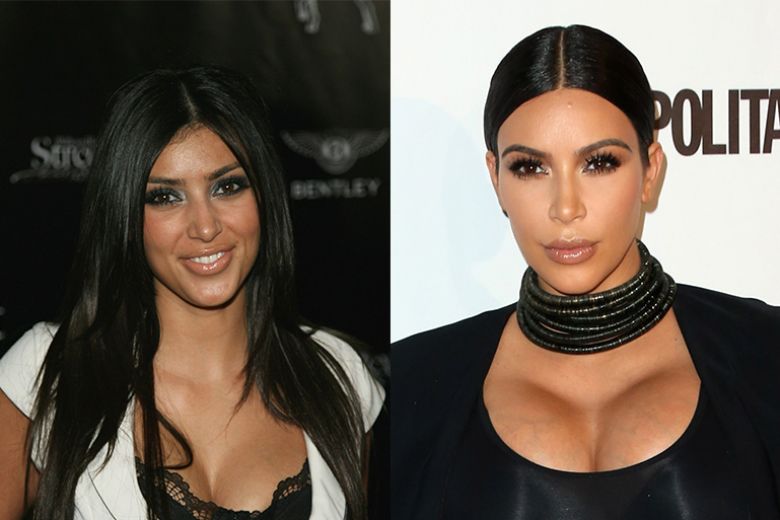 I Kardashian prima e dopo (parecchia) chirurgia estetica