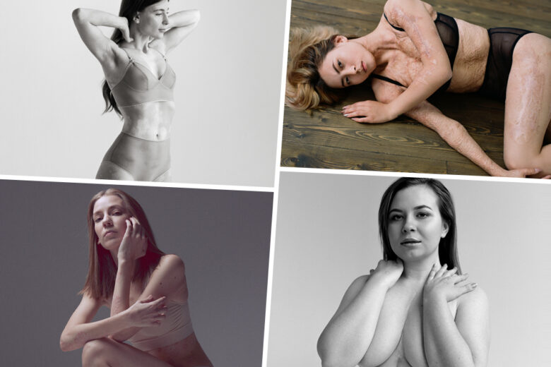 Project The Skin, raccontiamo le donne e la loro pelle: ogni cicatrice è una storia