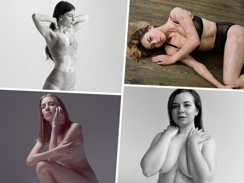 Project The Skin, raccontiamo le donne e la loro pelle: ogni cicatrice è una storia